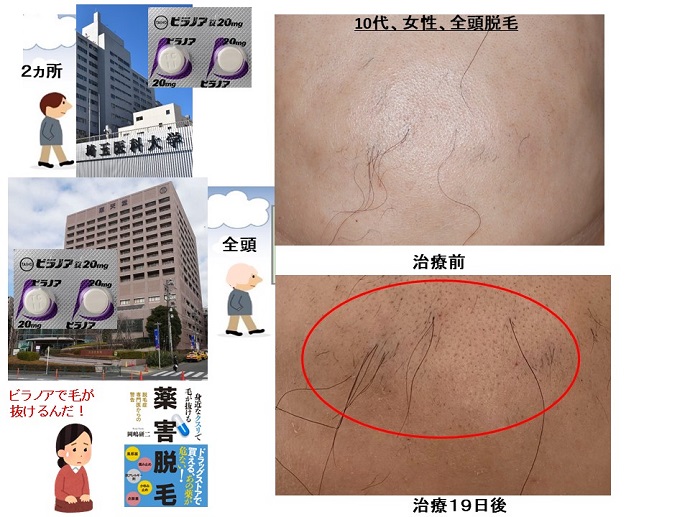 円形脱毛症　病院